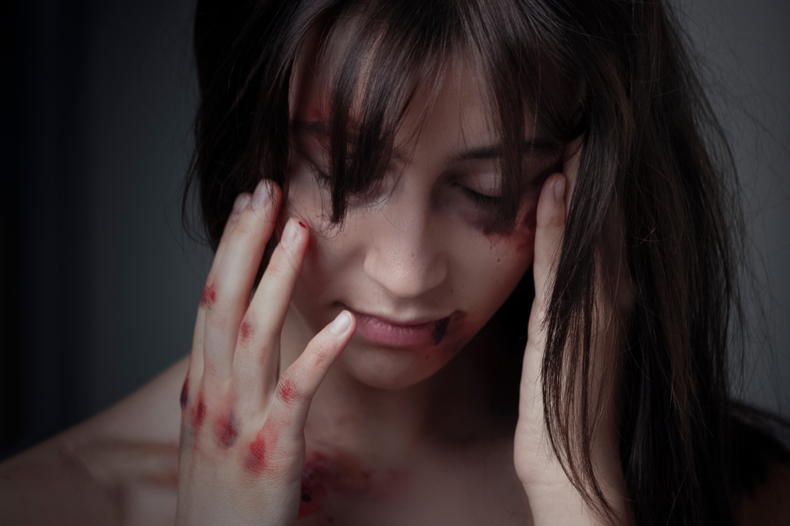 woman bruised self-harm